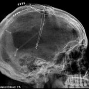Вживленный в мозг электрод, на который подается 130 импульсов в секунду, для стимуляции и предотвращения развития болезни Альцгеймера